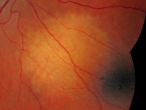 Amelanotic Choroidal Nevus 
45-year-old man   OD 20/20,  OS 20/20.  5x5 mm flat, yellow choroidal lesion just inferonasal to the optic nerve, two disc-diameters from the nerve with scalloped edges.   It looks like a confluent drusen, but it is not elevated. 
