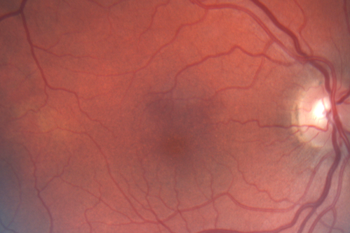 Acute Macular Neuroretinopathy - (AMN) - Spot in Vision OS - 40 Year old Female
