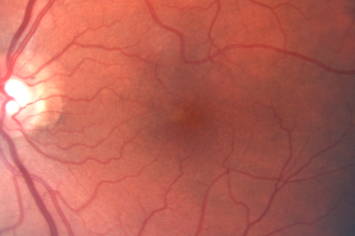 Acute Macular Neuroretinopathy - (AMN) - Spot in Vision OS - 40 Year old Female
Photos shows gray area nasal to the fovea
