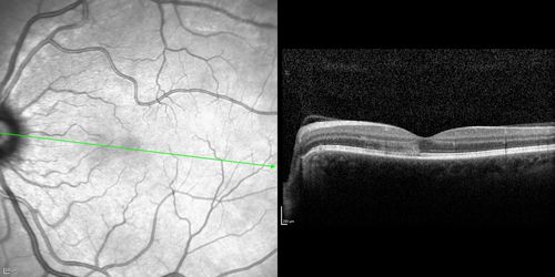Acute Macular Neuroretinopathy - (AMN) - Spot in Vision OS - 40 Year old Female
SD OCT shows disruption of the outer retina nasal to the fovea
