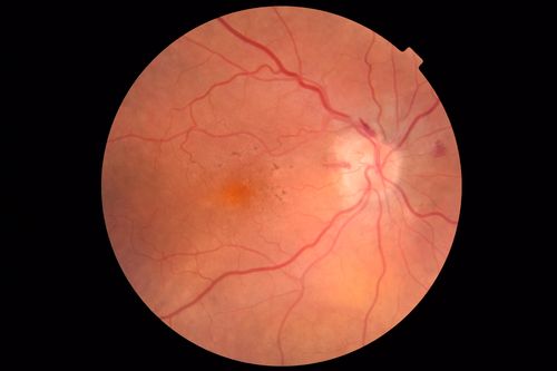 Anemic Retinopathy
Myelodysplasia - HgB 8 and very low platelet count

