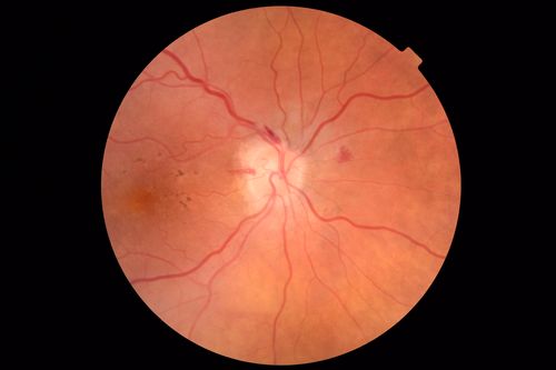 Anemic Retinopathy
Myelodysplasia - HgB 8 and very low platelet count
