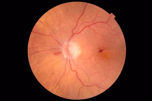 Anemic Retinopathy
Myelodysplasia - HgB 8 and very low platelet count
