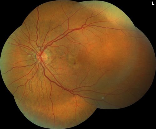 Angioid Streaks Scar and new CNVM
49 y/o WF with decreased vision x 1 month.  Her OD is 20/400 and her OS is seeing 20/70.  No cutaneous lesions or Ehlers-Danlos. The FP and FA  show a predominant classic CNV (with fibrosis) OD and an Occult CNV OS with what appears to be a RAP lesion.
