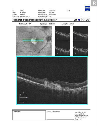 Angioid Streaks Scar and new CNVM
49 y/o WF with decreased vision x 1 month.  Her OD is 20/400 and her OS is seeing 20/70.  No cutaneous lesions or Ehlers-Danlos. The FP and FA  show a predominant classic CNV (with fibrosis) OD and an Occult CNV OS with what appears to be a RAP lesion.
