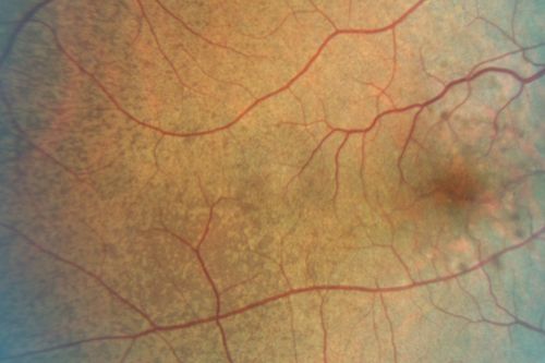 Angioid Streaks - Peau D'Orange - Pseudoxanthoma Elasticum - Asymptomatic Extrafoveal Choroidal Neovascular Membrane
60-year-old woman has pseudoxanthoma elasticum since 2008.  Her sister has the same problem and lost vision in both eyes.  She had a problem with blood vessel growth in the left eye for which she had injections of Avastin in August, September, and October of 2011 (5 months ago).  Subsequent to that, the macula has been dry and you have just been watching her carefully.  She is in Florida for a short time but will ultimately be spending nine months out of the year here.  Both of her eyes have good vision at 
