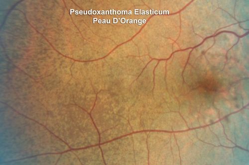 Angioid Streaks - Peau D'Orange - Pseudoxanthoma Elasticum - Asymptomatic Extrafoveal Choroidal Neovascular Membrane
60-year-old woman has pseudoxanthoma elasticum since 2008.  Her sister has the same problem and lost vision in both eyes.  She had a problem with blood vessel growth in the left eye for which she had injections of Avastin in August, September, and October of 2011 (5 months ago).  Subsequent to that, the macula has been dry and you have just been watching her carefully.  She is in Florida for a short time but will ultimately be spending nine months out of the year here.  Both of her eyes have good vision at 
