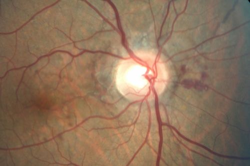 Angioid Streaks - Peau D'Orange - Pseudoxanthoma Elasticum - Asymptomatic Extrafoveal Choroidal Neovascular Membrane
60-year-old woman has pseudoxanthoma elasticum since 2008.  Her sister has the same problem and lost vision in both eyes.  She had a problem with blood vessel growth in the left eye for which she had injections of Avastin in August, September, and October of 2011 (5 months ago).  Subsequent to that, the macula has been dry and you have just been watching her carefully.  She is in Florida for a short time but will ultimately be spending nine months out of the year here.  Both of her eyes have good vision at 
