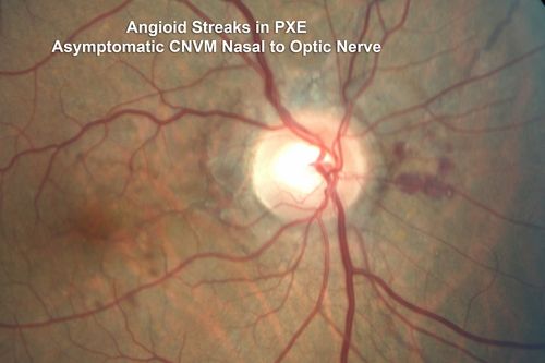 Angioid Streaks - Peau D'Orange - Pseudoxanthoma Elasticum - Asymptomatic Extrafoveal Choroidal Neovascular Membrane
60-year-old woman has pseudoxanthoma elasticum since 2008.  Her sister has the same problem and lost vision in both eyes.  She had a problem with blood vessel growth in the left eye for which she had injections of Avastin in August, September, and October of 2011 (5 months ago).  Subsequent to that, the macula has been dry and you have just been watching her carefully.  She is in Florida for a short time but will ultimately be spending nine months out of the year here.  Both of her eyes have good vision at 
