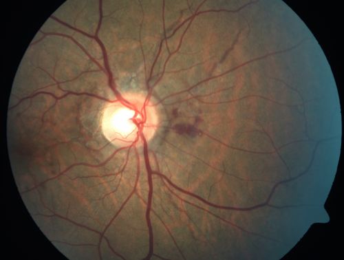 Angioid Streaks - Peau D'Orange - Pseudoxanthoma Elasticum - Asymptomatic Extrafoveal Choroidal Neovascular Membrane
60-year-old woman has pseudoxanthoma elasticum since 2008.  Her sister has the same problem and lost vision in both eyes.  She had a problem with blood vessel growth in the left eye for which she had injections of Avastin in August, September, and October of 2011 (5 months ago).  Subsequent to that, the macula has been dry and you have just been watching her carefully.  She is in Florida for a short time but will ultimately be spending nine months out of the year here.  Both of her eyes have good vision at 
