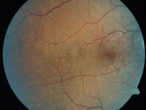 Angioid Streaks - Peau D'Orange - Pseudoxanthoma Elasticum - Asymptomatic Extrafoveal Choroidal Neovascular Membrane
60-year-old woman has pseudoxanthoma elasticum since 2008.  Her sister has the same problem and lost vision in both eyes.  She had a problem with blood vessel growth in the left eye for which she had injections of Avastin in August, September, and October of 2011 (5 months ago).  Subsequent to that, the macula has been dry and you have just been watching her carefully.  She is in Florida for a short time but will ultimately be spending nine months out of the year here.  Both of her eyes have good vision at 
