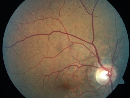 Angioid Streaks - Peau D'Orange - Pseudoxanthoma Elasticum - Asymptomatic Extrafoveal Choroidal Neovascular Membrane
60-year-old woman has pseudoxanthoma elasticum since 2008.  Her sister has the same problem and lost vision in both eyes.  She had a problem with blood vessel growth in the left eye for which she had injections of Avastin in August, September, and October of 2011 (5 months ago).  Subsequent to that, the macula has been dry and you have just been watching her carefully.  She is in Florida for a short time but will ultimately be spending nine months out of the year here.  Both of her eyes have good vision at 
