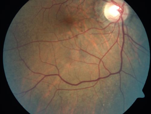 Angioid Streaks - Peau D'Orange - Pseudoxanthoma Elasticum - Asymptomatic Extrafoveal Choroidal Neovascular Membrane
60-year-old woman has pseudoxanthoma elasticum since 2008.  Her sister has the same problem and lost vision in both eyes.  She had a problem with blood vessel growth in the left eye for which she had injections of Avastin in August, September, and October of 2011 (5 months ago).  Subsequent to that, the macula has been dry and you have just been watching her carefully.  She is in Florida for a short time but will ultimately be spending nine months out of the year here.  Both of her eyes have good vision at 
