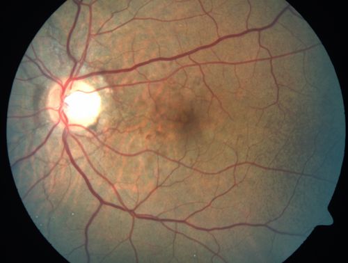 Angioid Streaks - Peau D'Orange - Pseudoxanthoma Elasticum - Asymptomatic Extrafoveal Choroidal Neovascular Membrane
60-year-old woman has pseudoxanthoma elasticum since 2008.  Her sister has the same problem and lost vision in both eyes.  She had a problem with blood vessel growth in the left eye for which she had injections of Avastin in August, September, and October of 2011 (5 months ago).  Subsequent to that, the macula has been dry and you have just been watching her carefully.  She is in Florida for a short time but will ultimately be spending nine months out of the year here.  Both of her eyes have good vision at 
