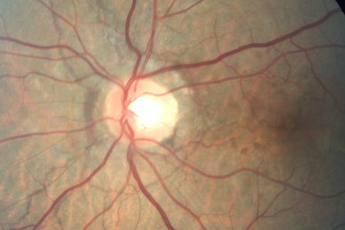 Angioid Streaks - Peau D'Orange - Pseudoxanthoma Elasticum - Asymptomatic Extrafoveal Choroidal Neovascular Membrane
60-year-old woman has pseudoxanthoma elasticum since 2008.  Her sister has the same problem and lost vision in both eyes.  She had a problem with blood vessel growth in the left eye for which she had injections of Avastin in August, September, and October of 2011 (5 months ago).  Subsequent to that, the macula has been dry and you have just been watching her carefully.  She is in Florida for a short time but will ultimately be spending nine months out of the year here.  Both of her eyes have good vision at 
