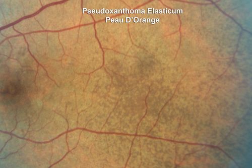 Angioid Streaks - Peau D'Orange - Pseudoxanthoma Elasticum - Asymptomatic Extrafoveal Choroidal Neovascular Membrane
60-year-old woman has pseudoxanthoma elasticum since 2008.  Her sister has the same problem and lost vision in both eyes.  She had a problem with blood vessel growth in the left eye for which she had injections of Avastin in August, September, and October of 2011 (5 months ago).  Subsequent to that, the macula has been dry and you have just been watching her carefully.  She is in Florida for a short time but will ultimately be spending nine months out of the year here.  Both of her eyes have good vision at 
