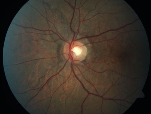 Angioid Streaks - Peau D'Orange - Pseudoxanthoma Elasticum - Asymptomatic Extrafoveal Choroidal Neovascular Membrane
60-year-old woman has pseudoxanthoma elasticum since 2008.  Her sister has the same problem and lost vision in both eyes.  She had a problem with blood vessel growth in the left eye for which she had injections of Avastin in August, September, and October of 2011 (5 months ago).  Subsequent to that, the macula has been dry and you have just been watching her carefully.  She is in Florida for a short time but will ultimately be spending nine months out of the year here.  Both of her eyes have good vision at 
