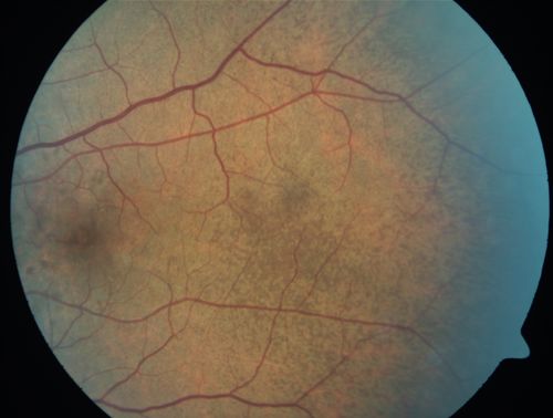 Angioid Streaks - Peau D'Orange - Pseudoxanthoma Elasticum - Asymptomatic Extrafoveal Choroidal Neovascular Membrane
60-year-old woman has pseudoxanthoma elasticum since 2008.  Her sister has the same problem and lost vision in both eyes.  She had a problem with blood vessel growth in the left eye for which she had injections of Avastin in August, September, and October of 2011 (5 months ago).  Subsequent to that, the macula has been dry and you have just been watching her carefully.  She is in Florida for a short time but will ultimately be spending nine months out of the year here.  Both of her eyes have good vision at 
