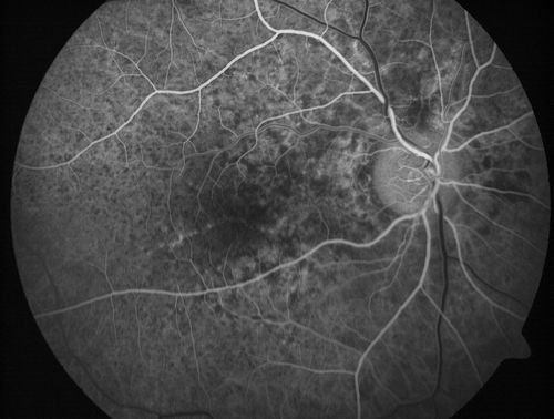 Angioid Streaks - Peau D'Orange - Pseudoxanthoma Elasticum - Asymptomatic Extrafoveal Choroidal Neovascular Membrane
60-year-old woman has pseudoxanthoma elasticum since 2008.  Her sister has the same problem and lost vision in both eyes.  She had a problem with blood vessel growth in the left eye for which she had injections of Avastin in August, September, and October of 2011 (5 months ago).  Subsequent to that, the macula has been dry and you have just been watching her carefully.  She is in Florida for a short time but will ultimately be spending nine months out of the year here.  Both of her eyes have good vision at 

