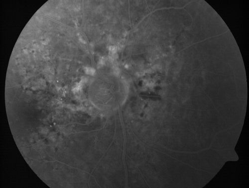 Angioid Streaks - Peau D'Orange - Pseudoxanthoma Elasticum - Asymptomatic Extrafoveal Choroidal Neovascular Membrane
60-year-old woman has pseudoxanthoma elasticum since 2008.  Her sister has the same problem and lost vision in both eyes.  She had a problem with blood vessel growth in the left eye for which she had injections of Avastin in August, September, and October of 2011 (5 months ago).  Subsequent to that, the macula has been dry and you have just been watching her carefully.  She is in Florida for a short time but will ultimately be spending nine months out of the year here.  Both of her eyes have good vision at 

