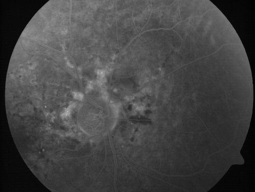 Angioid Streaks - Peau D'Orange - Pseudoxanthoma Elasticum - Asymptomatic Extrafoveal Choroidal Neovascular Membrane
60-year-old woman has pseudoxanthoma elasticum since 2008.  Her sister has the same problem and lost vision in both eyes.  She had a problem with blood vessel growth in the left eye for which she had injections of Avastin in August, September, and October of 2011 (5 months ago).  Subsequent to that, the macula has been dry and you have just been watching her carefully.  She is in Florida for a short time but will ultimately be spending nine months out of the year here.  Both of her eyes have good vision at 
