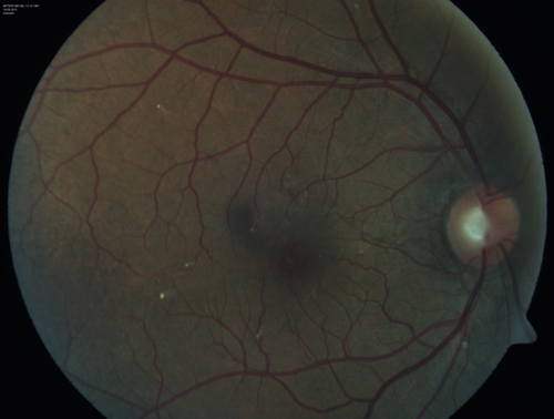 Angioid Streaks - CNVM OS with vision loss
48 year old soccer player.  Prior trauma OS (with soccer ball).  Vision loss for 3 weeks to 20/60 - with Lucentis vision improved to 20/30

