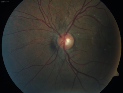 Angioid Streaks - CNVM OS with vision loss
48 year old soccer player.  Prior trauma OS (with soccer ball).  Vision loss for 3 weeks to 20/60 - with Lucentis vision improved to 20/30
