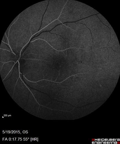 Angioid Streaks - CNVM OS with vision loss
48 year old soccer player.  Prior trauma OS (with soccer ball).  Vision loss for 3 weeks to 20/60 - with Lucentis vision improved to 20/30
