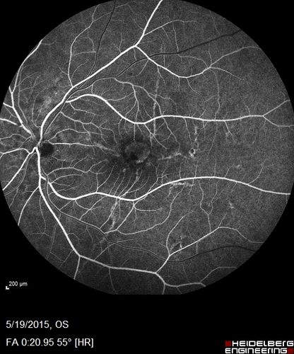 Angioid Streaks - CNVM OS with vision loss
48 year old soccer player.  Prior trauma OS (with soccer ball).  Vision loss for 3 weeks to 20/60 - with Lucentis vision improved to 20/30
