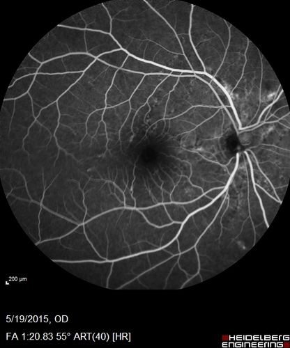 Angioid Streaks - CNVM OS with vision loss
48 year old soccer player.  Prior trauma OS (with soccer ball).  Vision loss for 3 weeks to 20/60 - with Lucentis vision improved to 20/30
