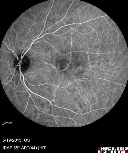 Angioid Streaks - CNVM OS with vision loss
48 year old soccer player.  Prior trauma OS (with soccer ball).  Vision loss for 3 weeks to 20/60 - with Lucentis vision improved to 20/30
