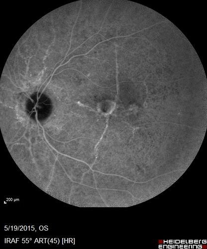 Angioid Streaks - CNVM OS with vision loss
48 year old soccer player.  Prior trauma OS (with soccer ball).  Vision loss for 3 weeks to 20/60 - with Lucentis vision improved to 20/30
