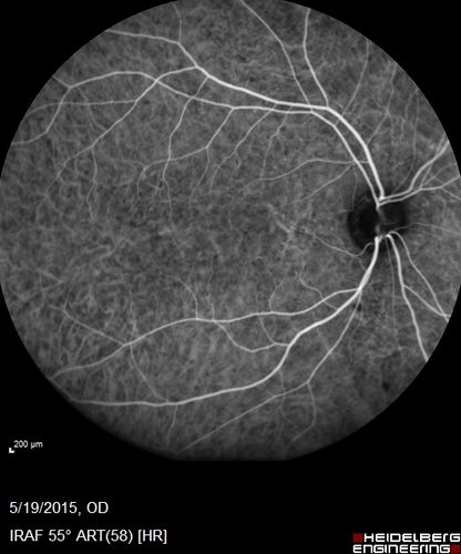 Angioid Streaks - CNVM OS with vision loss
48 year old soccer player.  Prior trauma OS (with soccer ball).  Vision loss for 3 weeks to 20/60 - with Lucentis vision improved to 20/30
