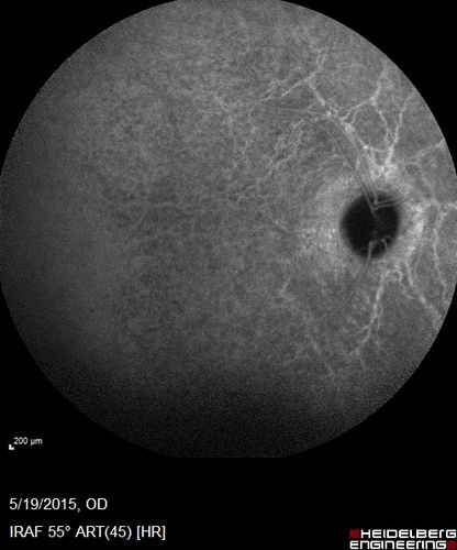 Angioid Streaks - CNVM OS with vision loss
48 year old soccer player.  Prior trauma OS (with soccer ball).  Vision loss for 3 weeks to 20/60 - with Lucentis vision improved to 20/30
