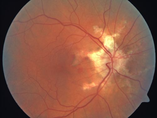 Angioid Streaks - New Extrafoveal Choroidal Neovascular Membrane Right Eye
61-year-old woman twelve days ago, saw a spot to the right of her central vision.   OD is 20/25, OS is 20/25
Treated with one year of avastin with good result and no vision loss.

