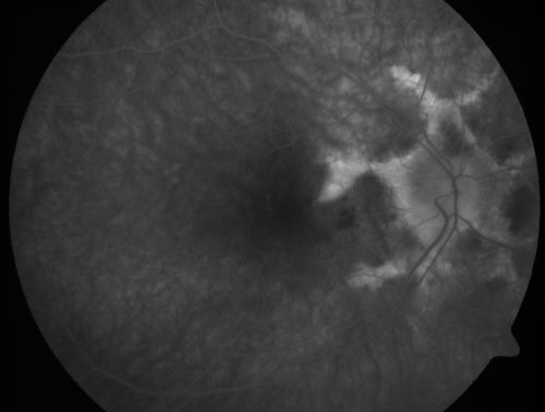 Angioid Streaks - New Extrafoveal Choroidal Neovascular Membrane Right Eye
61-year-old woman twelve days ago, saw a spot to the right of her central vision.   OD is 20/25, OS is 20/25

Treated with one year of avastin with good result and no vision loss.
