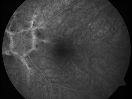 Angioid Streaks - New Extrafoveal Choroidal Neovascular Membrane Right Eye
61-year-old woman twelve days ago, saw a spot to the right of her central vision.   OD is 20/25, OS is 20/25
Treated with one year of avastin with good result and no vision loss.
