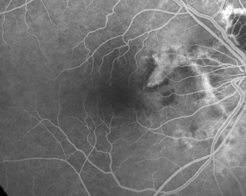 Angioid Streaks - New Extrafoveal Choroidal Neovascular Membrane Right Eye
61-year-old woman twelve days ago, saw a spot to the right of her central vision.   OD is 20/25, OS is 20/25
Treated with one year of avastin with good result and no vision loss.
