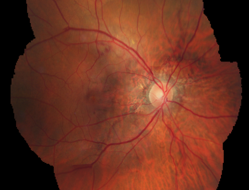 Angioid Streaks New Vision Change in Good Right Eye Treated with Lucentis
53-year-old man has angioid streaks.  He has a macular scar in the left eye from choroidal neovasculari-zation that was treated with photodynamic laser 5-8 years ago.  His vision in the right eye had been fine until about a week ago when he noticed temporally in the right eye an area that does not look normal and looks a little distorted.
VISUAL ACUITY: Vision OD is 20/30, OS is 20/400.  Treatment was started within a month and patient responded well and is now 3 years out requiring every 3 month Lucentis
