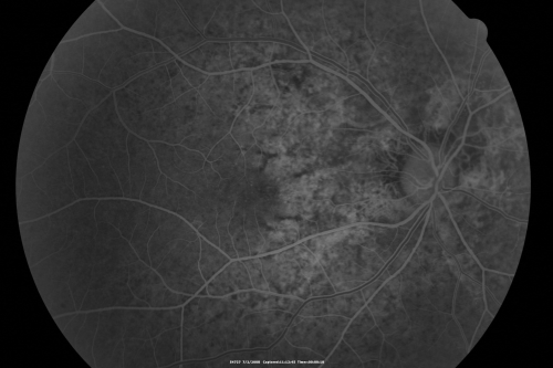 Angioid Streaks New Vision Change in Good Right Eye Treated with Lucentis
53-year-old man has angioid streaks.  He has a macular scar in the left eye from choroidal neovasculari-zation that was treated with photodynamic laser 5-8 years ago.  His vision in the right eye had been fine until about a week ago when he noticed temporally in the right eye an area that does not look normal and looks a little distorted.
VISUAL ACUITY: Vision OD is 20/30, OS is 20/400.  Treatment was started within a month and patient responded well and is now 3 years out requiring every 3 month Lucentis
