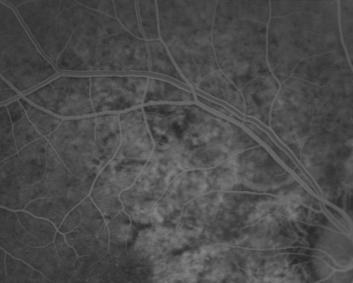 Angioid Streaks New Vision Change in Good Right Eye Treated with Lucentis
53-year-old man has angioid streaks.  He has a macular scar in the left eye from choroidal neovasculari-zation that was treated with photodynamic laser 5-8 years ago.  His vision in the right eye had been fine until about a week ago when he noticed temporally in the right eye an area that does not look normal and looks a little distorted.
VISUAL ACUITY: Vision OD is 20/30, OS is 20/400.  Treatment was started within a month and patient responded well and is now 3 years out requiring every 3 month Lucentis
