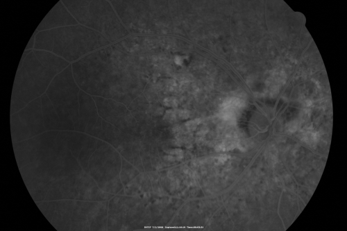 Angioid Streaks New Vision Change in Good Right Eye Treated with Lucentis
53-year-old man has angioid streaks.  He has a macular scar in the left eye from choroidal neovasculari-zation that was treated with photodynamic laser 5-8 years ago.  His vision in the right eye had been fine until about a week ago when he noticed temporally in the right eye an area that does not look normal and looks a little distorted.
VISUAL ACUITY: Vision OD is 20/30, OS is 20/400.  Treatment was started within a month and patient responded well and is now 3 years out requiring every 3 month Lucentis
