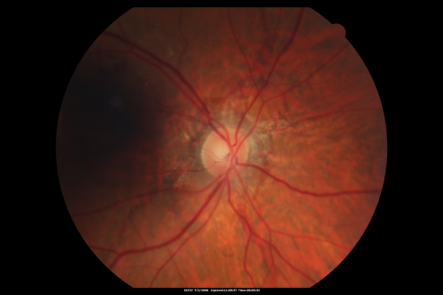 Angioid Streaks New Vision Change in Good Right Eye Treated with Lucentis
53-year-old man has angioid streaks.  He has a macular scar in the left eye from choroidal neovasculari-zation that was treated with photodynamic laser 5-8 years ago.  His vision in the right eye had been fine until about a week ago when he noticed temporally in the right eye an area that does not look normal and looks a little distorted.
VISUAL ACUITY: Vision OD is 20/30, OS is 20/400.  Treatment was started within a month and patient responded well and is now 3 years out requiring every 3 month Lucentis
