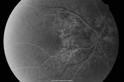 Angioid Streaks New Vision Change in Good Right Eye Treated with Lucentis
53-year-old man has angioid streaks.  He has a macular scar in the left eye from choroidal neovasculari-zation that was treated with photodynamic laser 5-8 years ago.  His vision in the right eye had been fine until about a week ago when he noticed temporally in the right eye an area that does not look normal and looks a little distorted.
VISUAL ACUITY: Vision OD is 20/30, OS is 20/400.  Treatment was started within a month and patient responded well and is now 3 years out requiring every 3 month Lucentis

