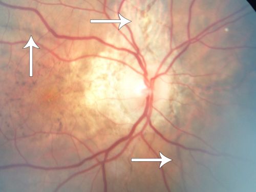 Angioid Streaks - Pseudoxanthoma Elasticum - Supressed CNVM
54-year-old woman had angioid streaks and macular degeneration in both eyes.  She has had intravitreal Avastin in the right eye about every three months and her vision in that eye is good.

VISUAL ACUITY:  Vision OD is 20/30, OS is 2/200
