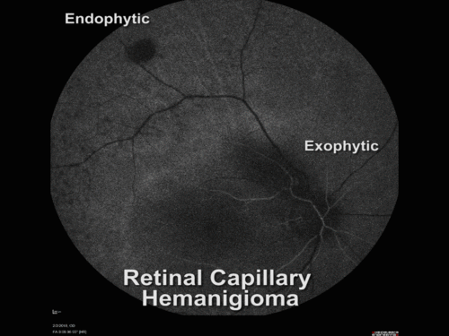 Retinal Capillary Hemangiomas - Endophytic and Exophytic - Animated GIF of FA fill
The endophytic tumor has a feeder vessel
