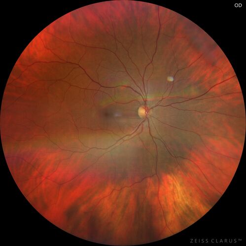 Retinal Angioma
46 year old female - Her original reason for an eye examination was that she had been in a car accident.  Then she saw that the vision was blurry in just the left eye.  Prior to that she had no known vision changes.  Since the accident she notices that her vision is better and her headaches are getting less bothersome.
PMhx benign, Meds: none
VA OD: Dcc20/20
VA OS: Dcc20/25
