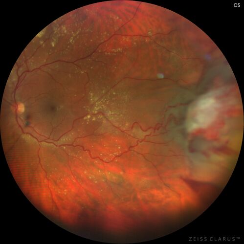 Retinal Angioma
46 year old female - Her original reason for an eye examination was that she had been in a car accident.  Then she saw that the vision was blurry in just the left eye.  Prior to that she had no known vision changes.  Since the accident she notices that her vision is better and her headaches are getting less bothersome.
PMhx benign, Meds: none
VA OD: Dcc20/20
VA OS: Dcc20/25
