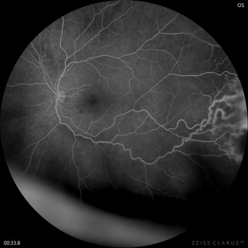 Retinal Angioma
46 year old female - Her original reason for an eye examination was that she had been in a car accident.  Then she saw that the vision was blurry in just the left eye.  Prior to that she had no known vision changes.  Since the accident she notices that her vision is better and her headaches are getting less bothersome.
PMhx benign, Meds: none
VA OD: Dcc20/20
VA OS: Dcc20/25
