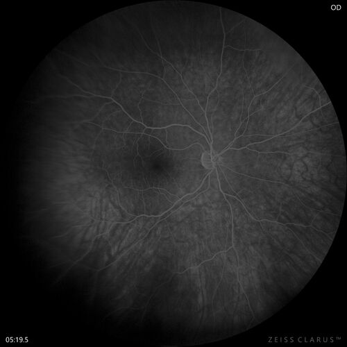 Retinal Angioma
46 year old female - Her original reason for an eye examination was that she had been in a car accident.  Then she saw that the vision was blurry in just the left eye.  Prior to that she had no known vision changes.  Since the accident she notices that her vision is better and her headaches are getting less bothersome.
PMhx benign, Meds: none
VA OD: Dcc20/20
VA OS: Dcc20/25
